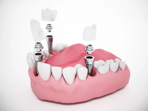 Dental Implant Surgery