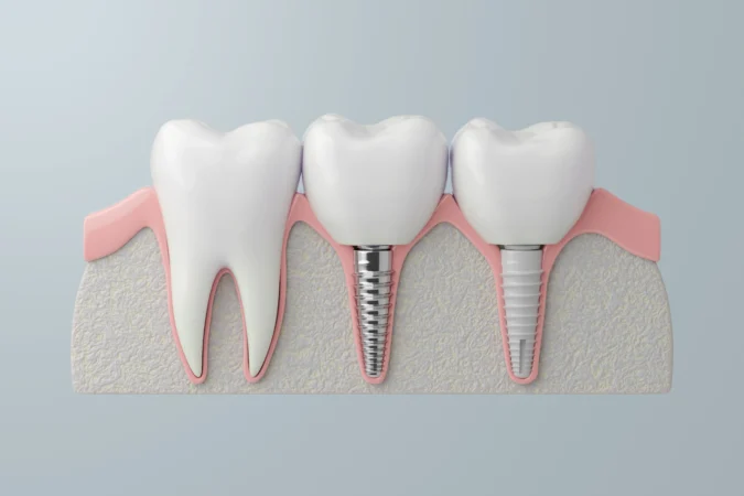 Dental Implants Istanbul,Turkey