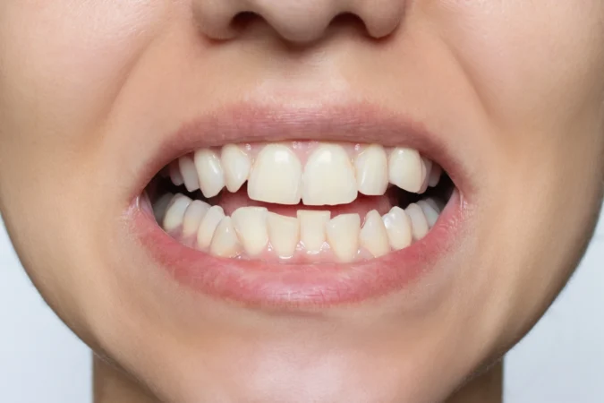 Comment corriger les dents de travers?