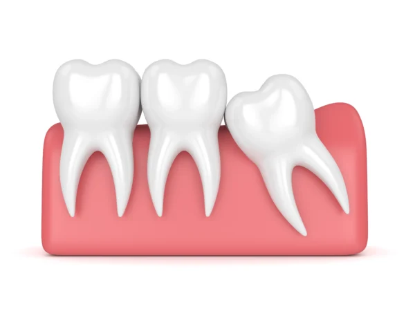 Tout ce que vous devez savoir sur le traitement des dents incluses