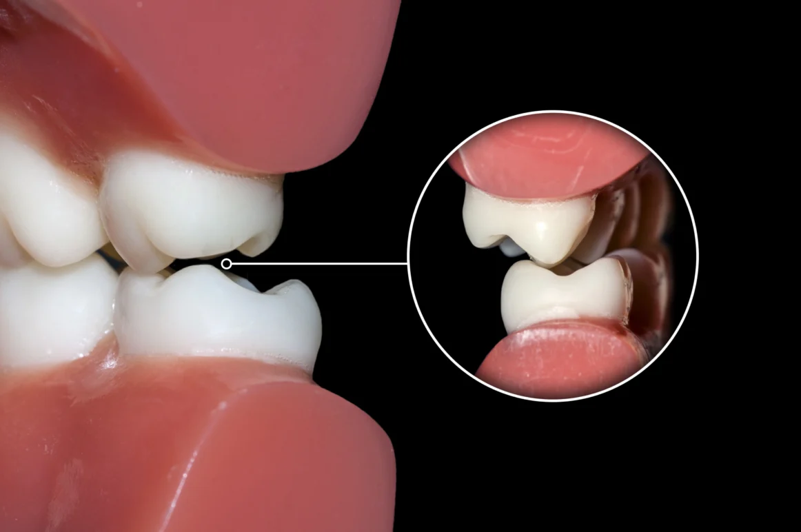 Bruxism (teeth grinding) – Symptoms and causes