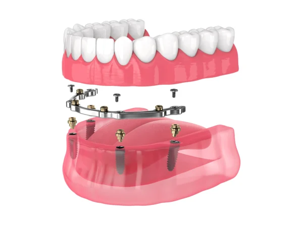 Full Mouth Dental Implants in Istanbul, Turkey