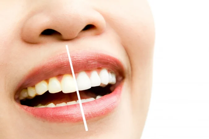 Tooth Discoloration Causes and Treatments