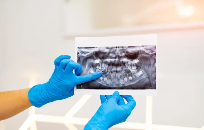 Wisdom Tooth Removal: Recovery Tips and Aftercare
