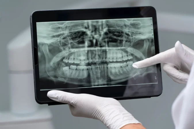 What Are Zygomatic Implants? Exploring Options