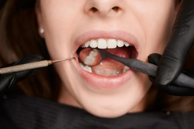 Dental Inlays and Onlays: A Comprehensive Guide