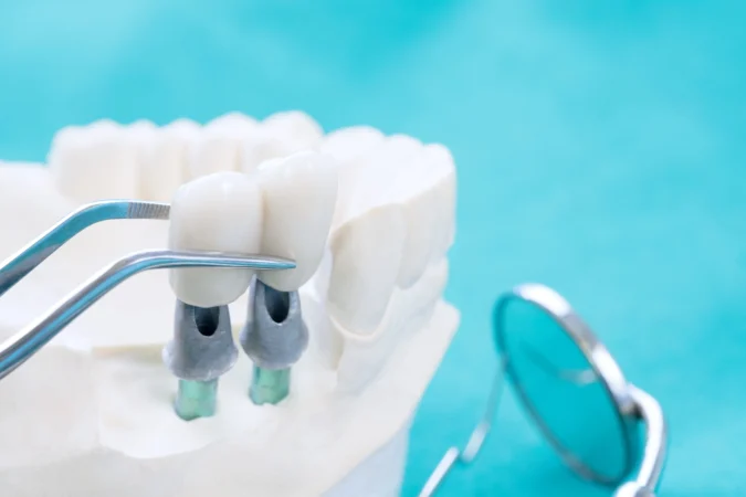 Discover the Types of Dental Implants Available in Turkey