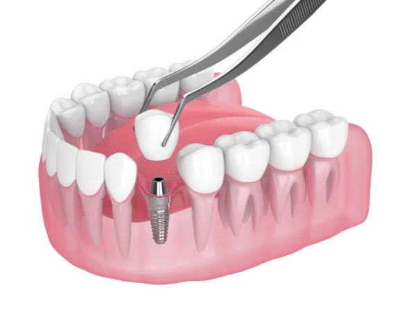 How Safe Are Dental Implants?