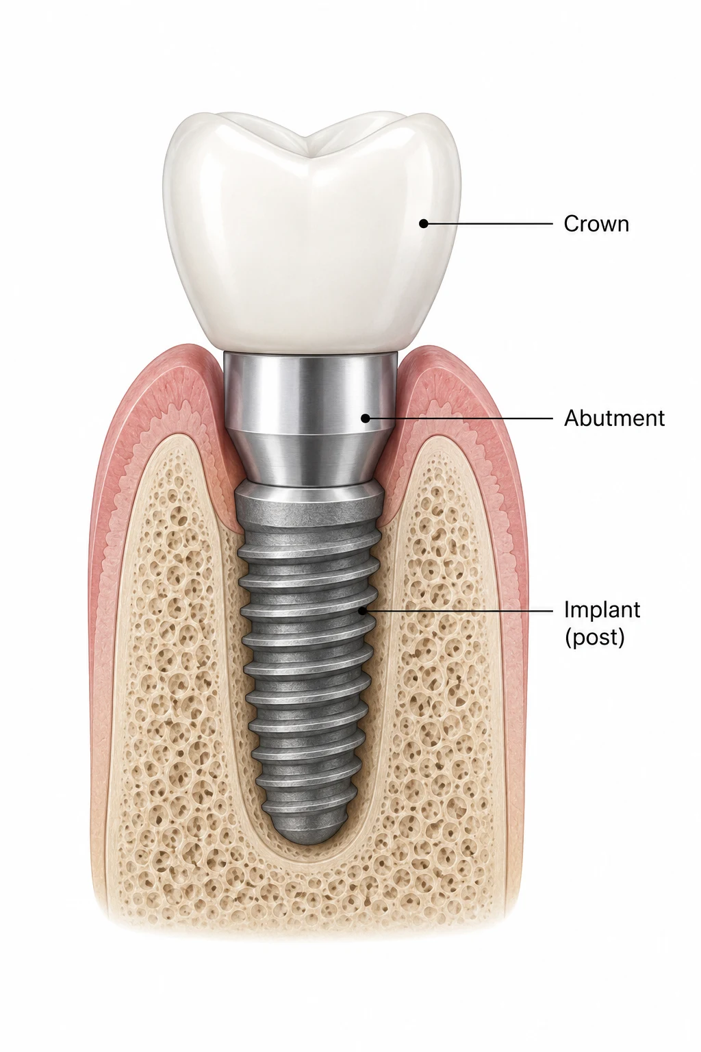 Illustration of a single dental implant showing the crown, abutment, and titanium implant post integrated with the jawbone and surrounding gum tissue.