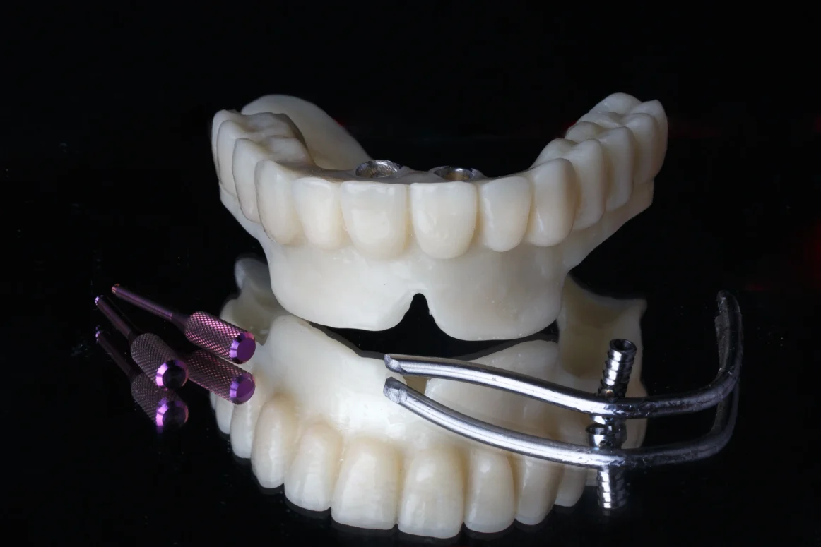 Extensive Guide Towards Malo Bridge Dental