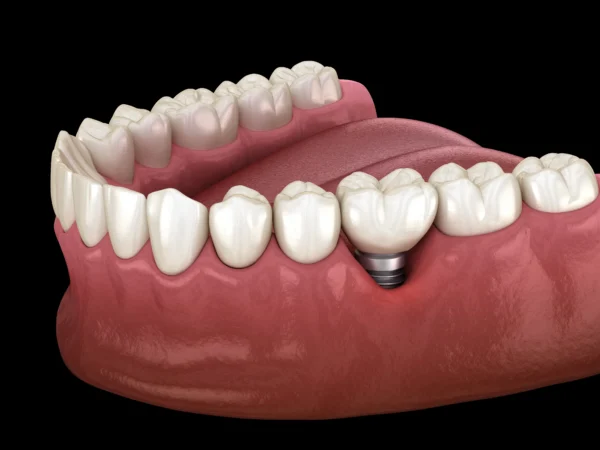 Peri-implantitis Treatment In Turkey