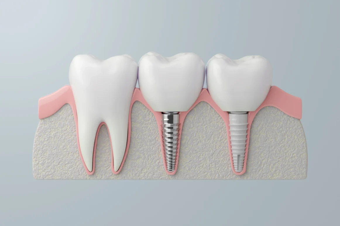 Dental Implants Abroad: Everything You Need To Know