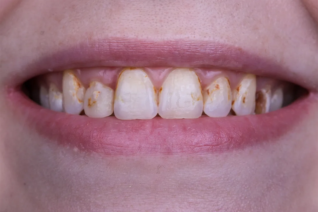 Dental Veneers: Veneer smile