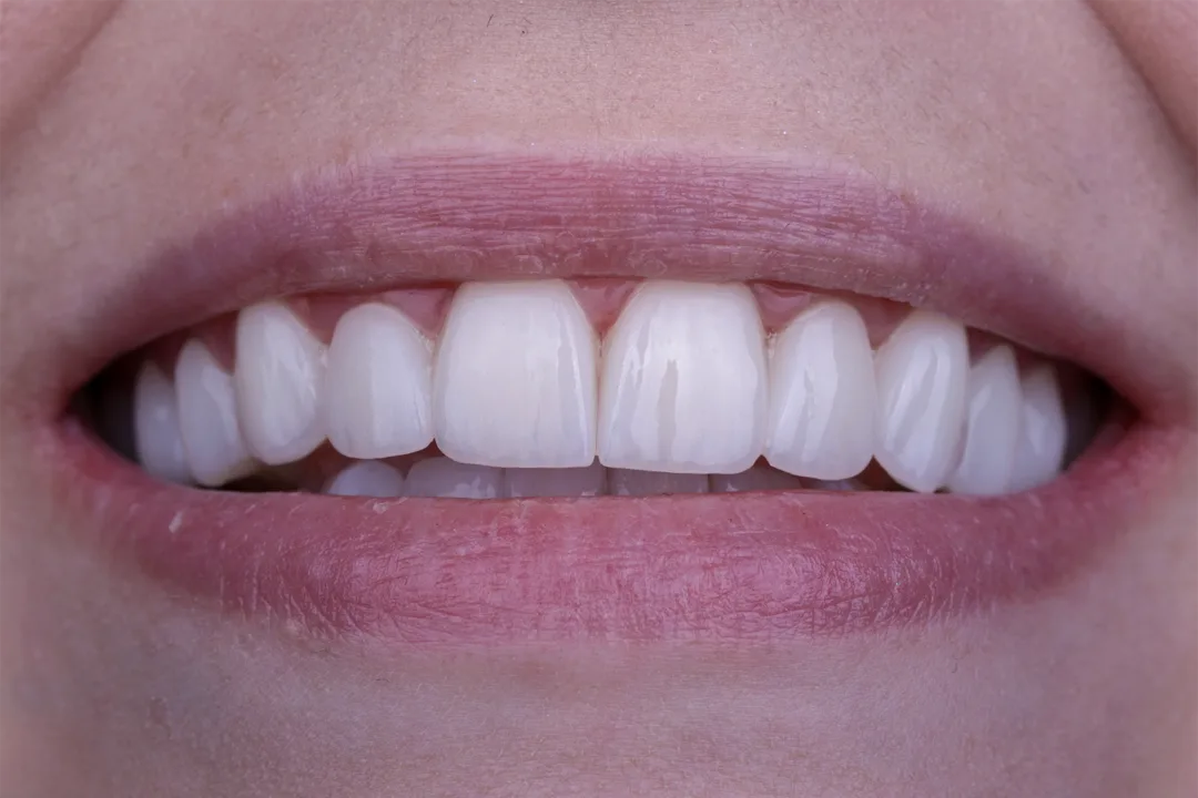Dental Veneers: Veneer smile