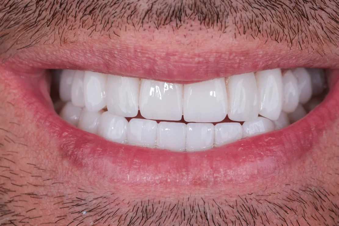 Dental Veneers: Veneer smile
