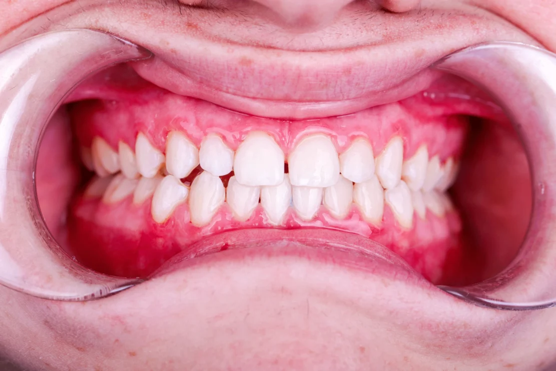 Blanchiment dentaire: Sourire éclatant.