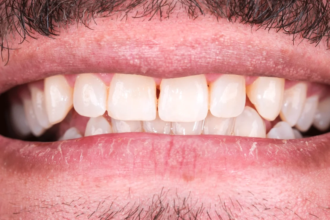 Teeth Whitening: Brighter smile