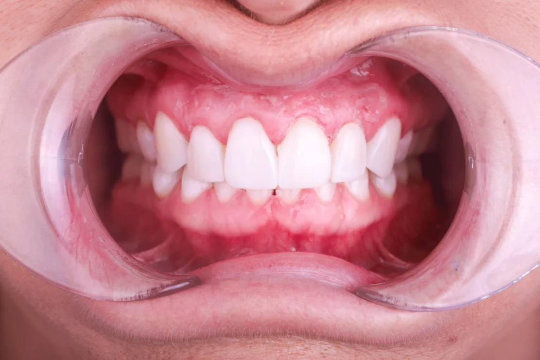 Composite Bonding: Tooth fixes