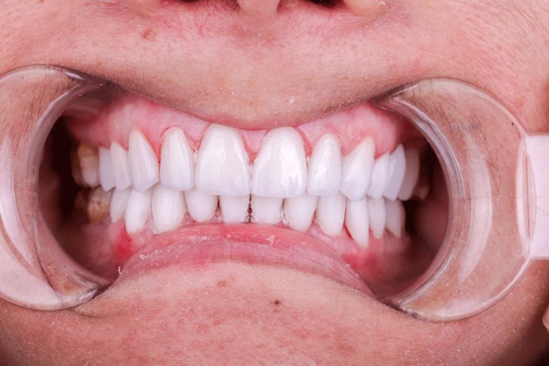 Dental Crowns: Dental caps