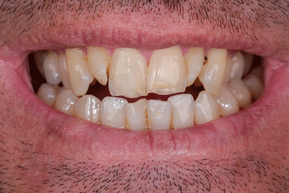 Dental Veneers: Veneer smile