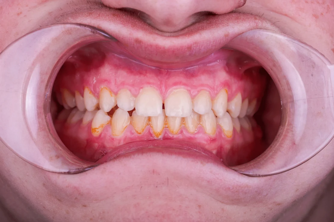 Blanchiment dentaire: Sourire éclatant.