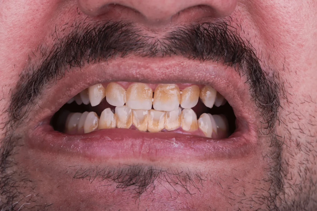 Teeth Whitening: Brighter smile