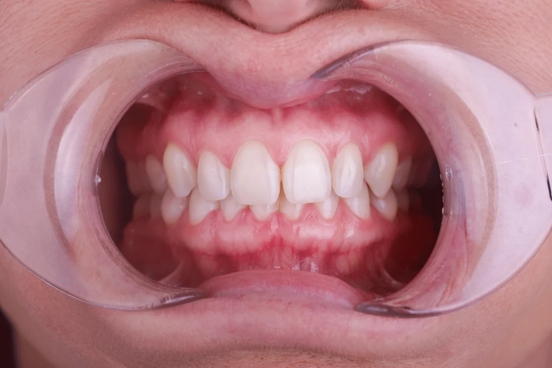 Composite Bonding: Tooth fixes