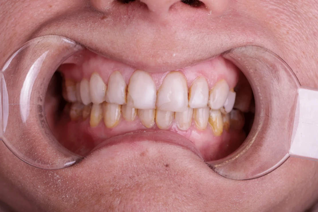 Dental Crowns: Dental caps