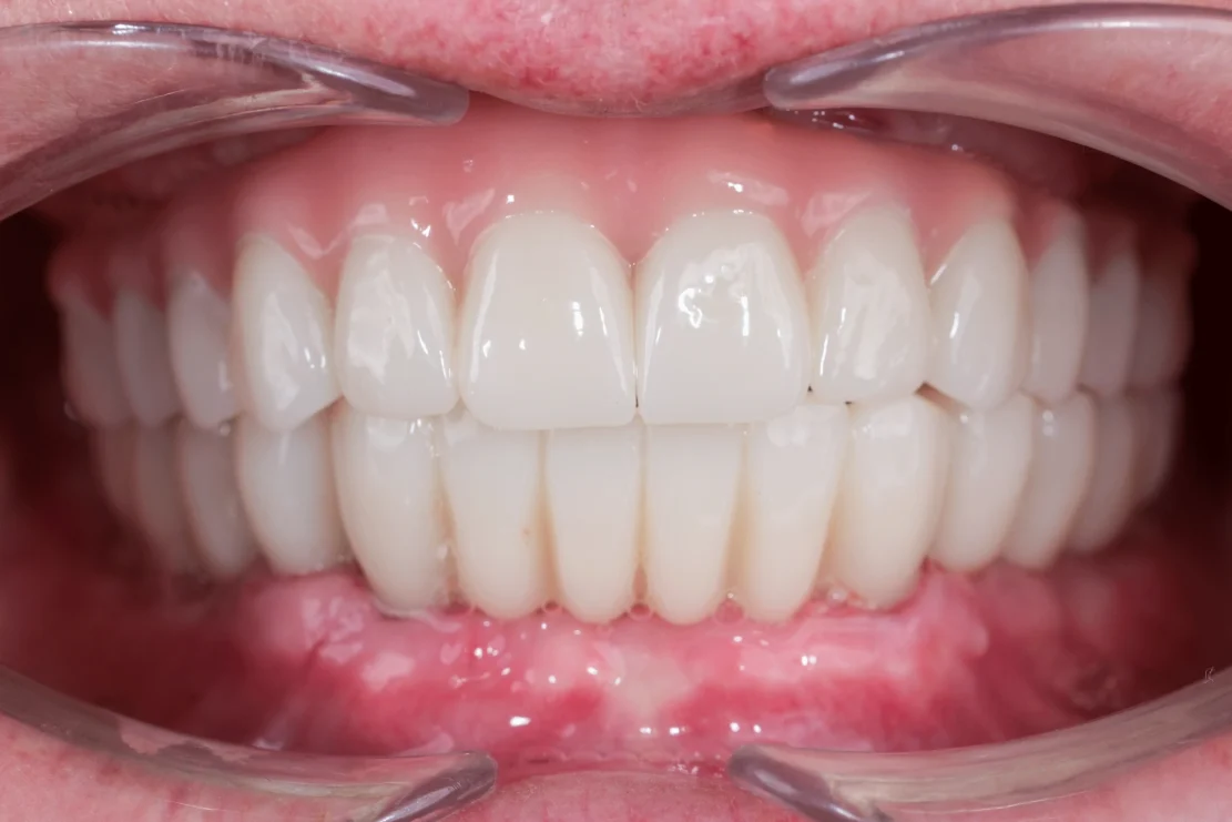 Hollywood Smile: Custom veneers