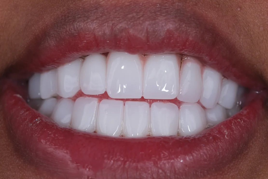Hollywood Smile: Custom veneers
