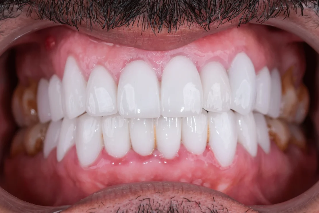 Root Canal: Treats infections