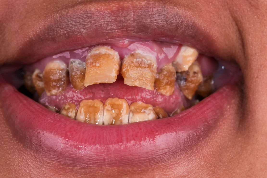 Hollywood Smile: Custom veneers
