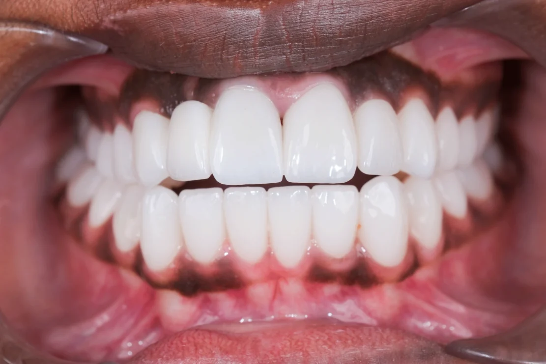 Gum Alignment: Balanced Smile