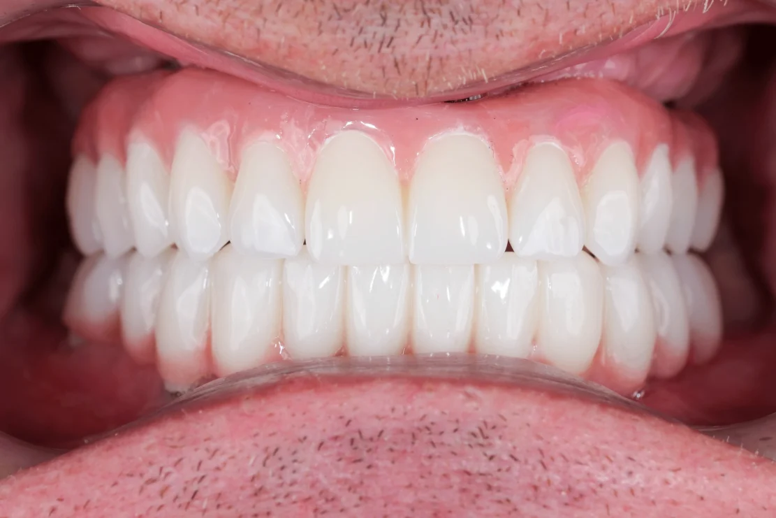Implants for Multiple Teeth: Implant restoration