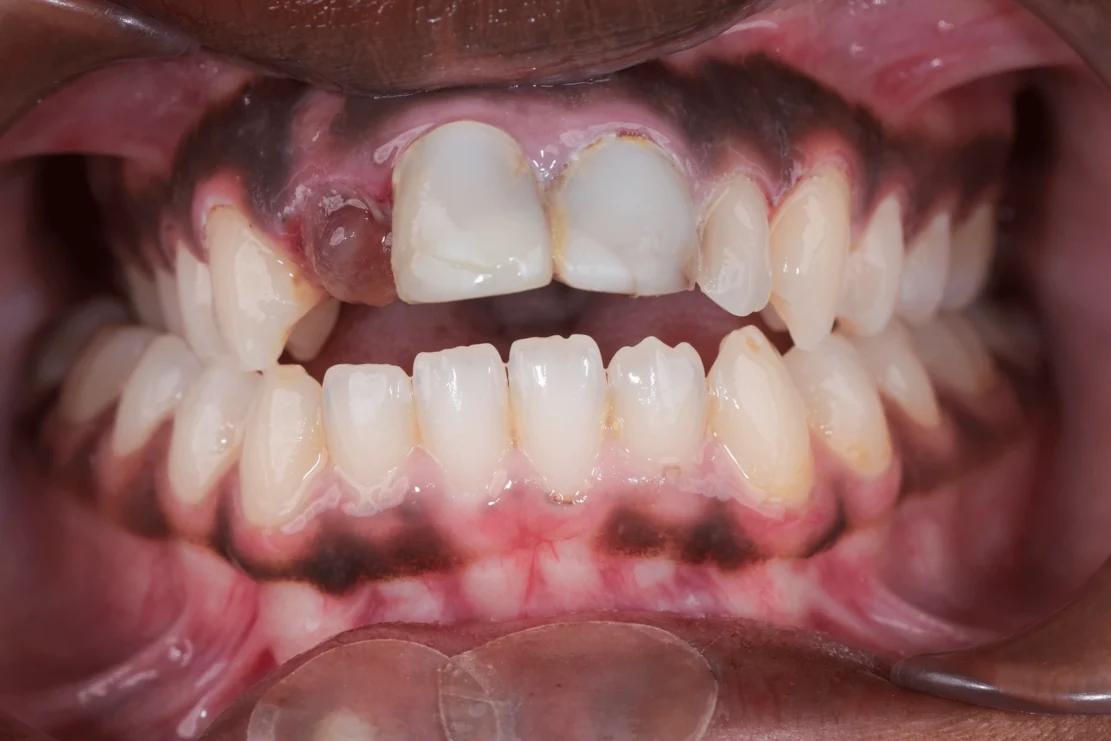 Gum Alignment: Balanced Smile