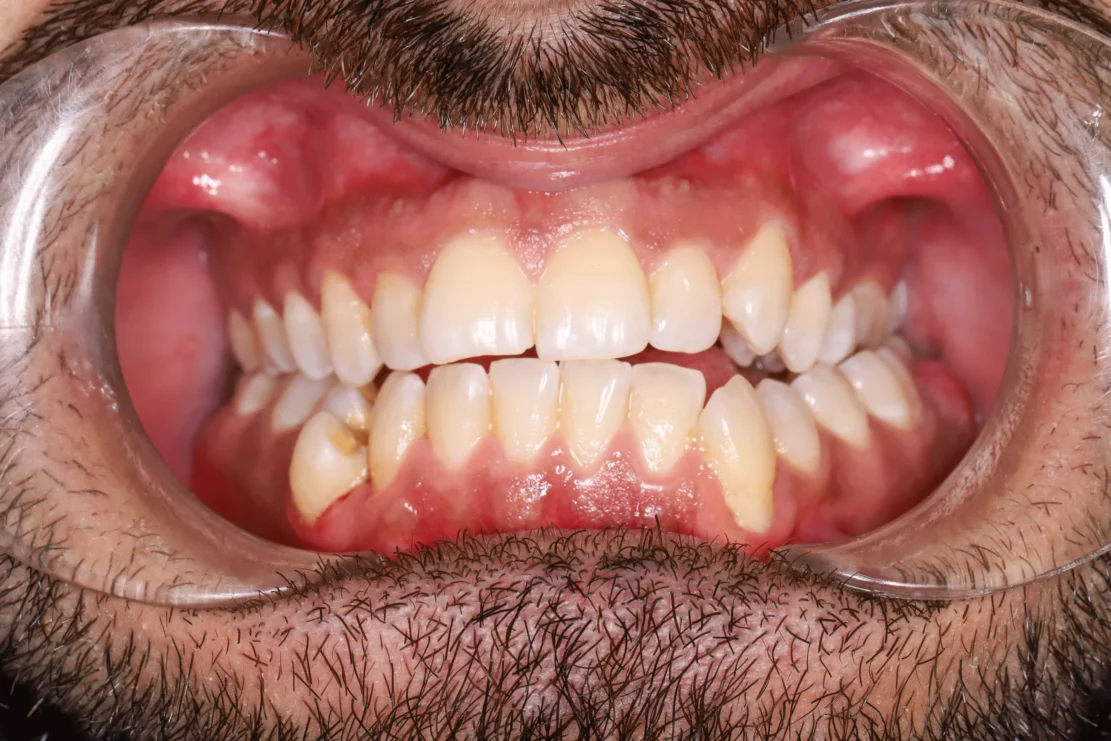 Composite Bonding: Tooth fixes