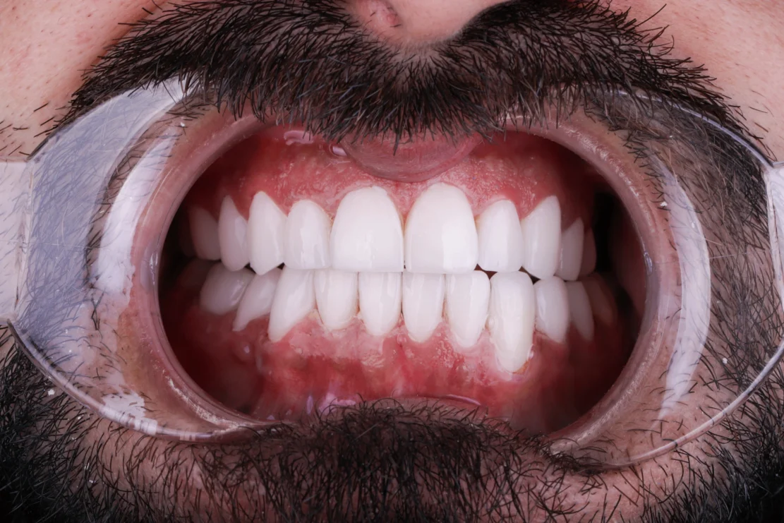 Composite Bonding: Tooth fixes
