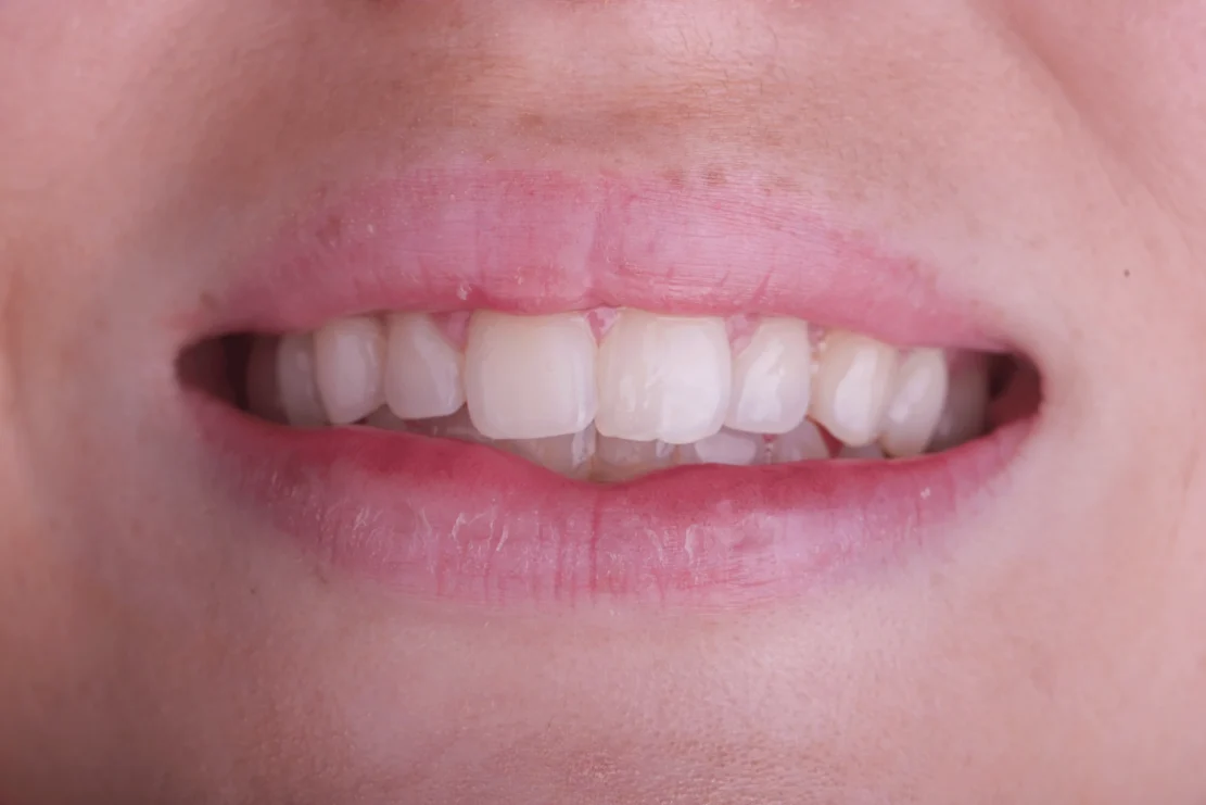 Before Image