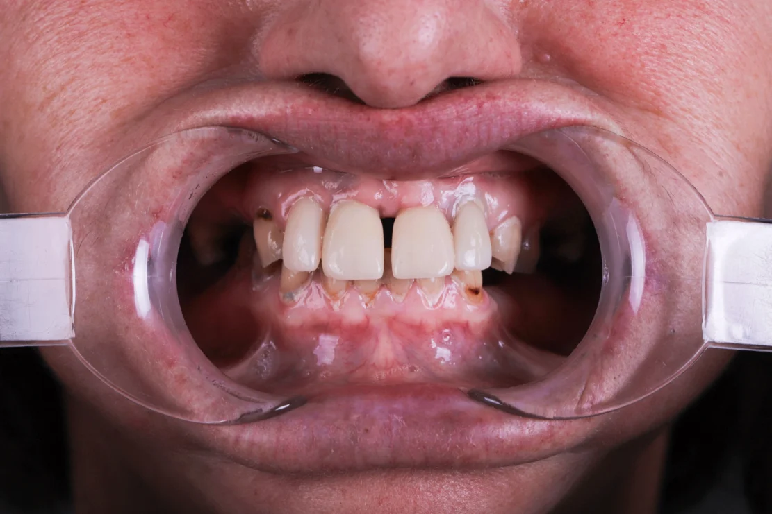 Hollywood Smile: Custom veneers