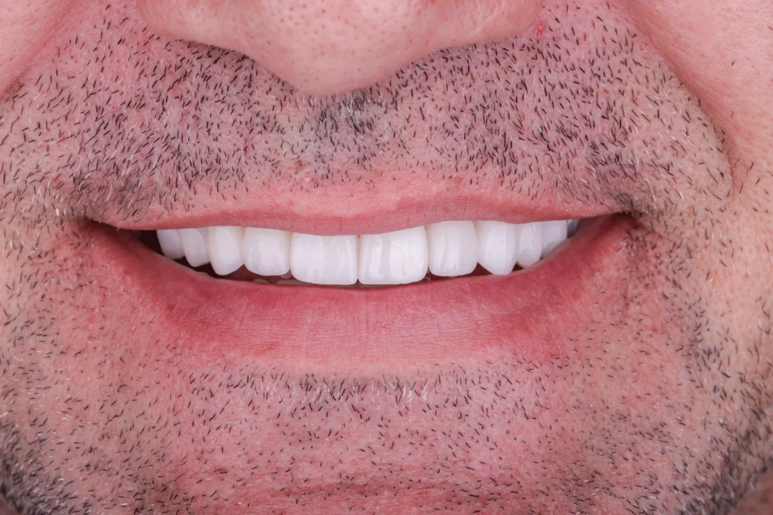 Dental Veneers: Veneer smile