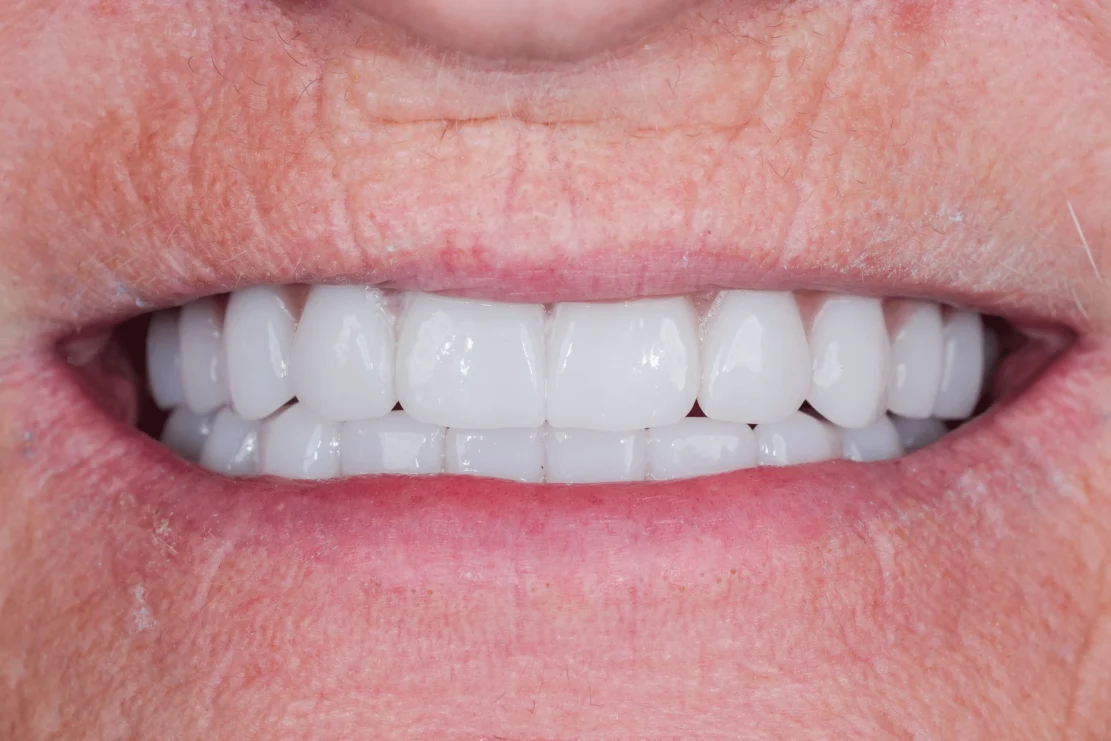 Tooth Implant Procedure: Implant teeth