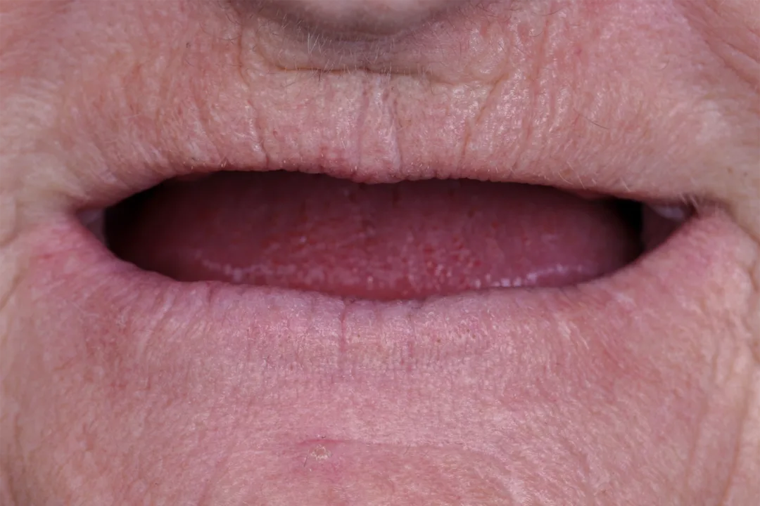 Tooth Implant Procedure: Implant teeth