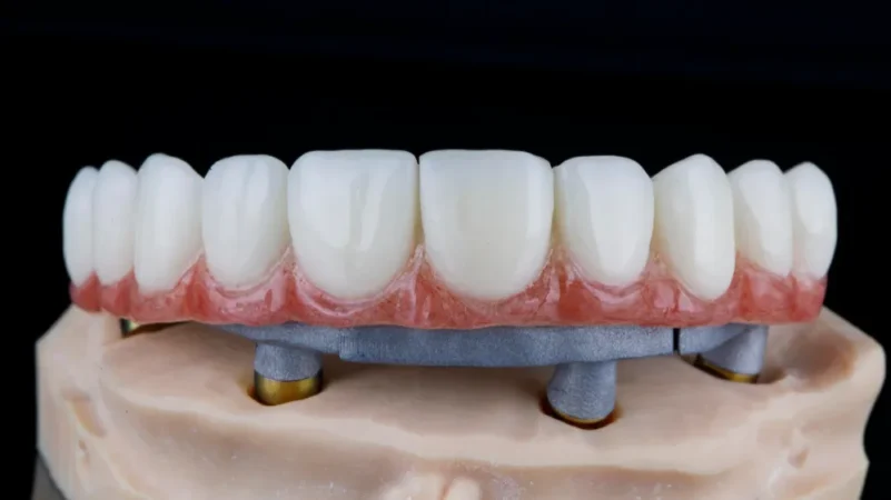 All-on-4 Dental Implants: A Full Smile Restored by Specialists