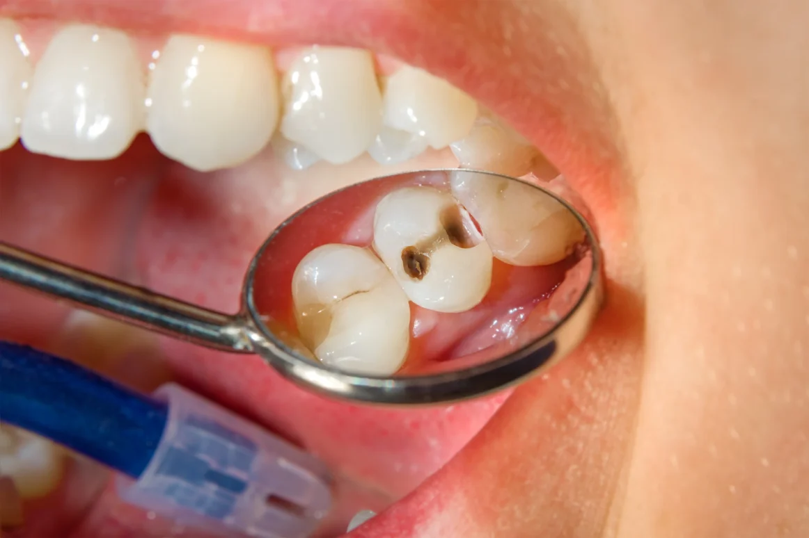 Composite Fillings
