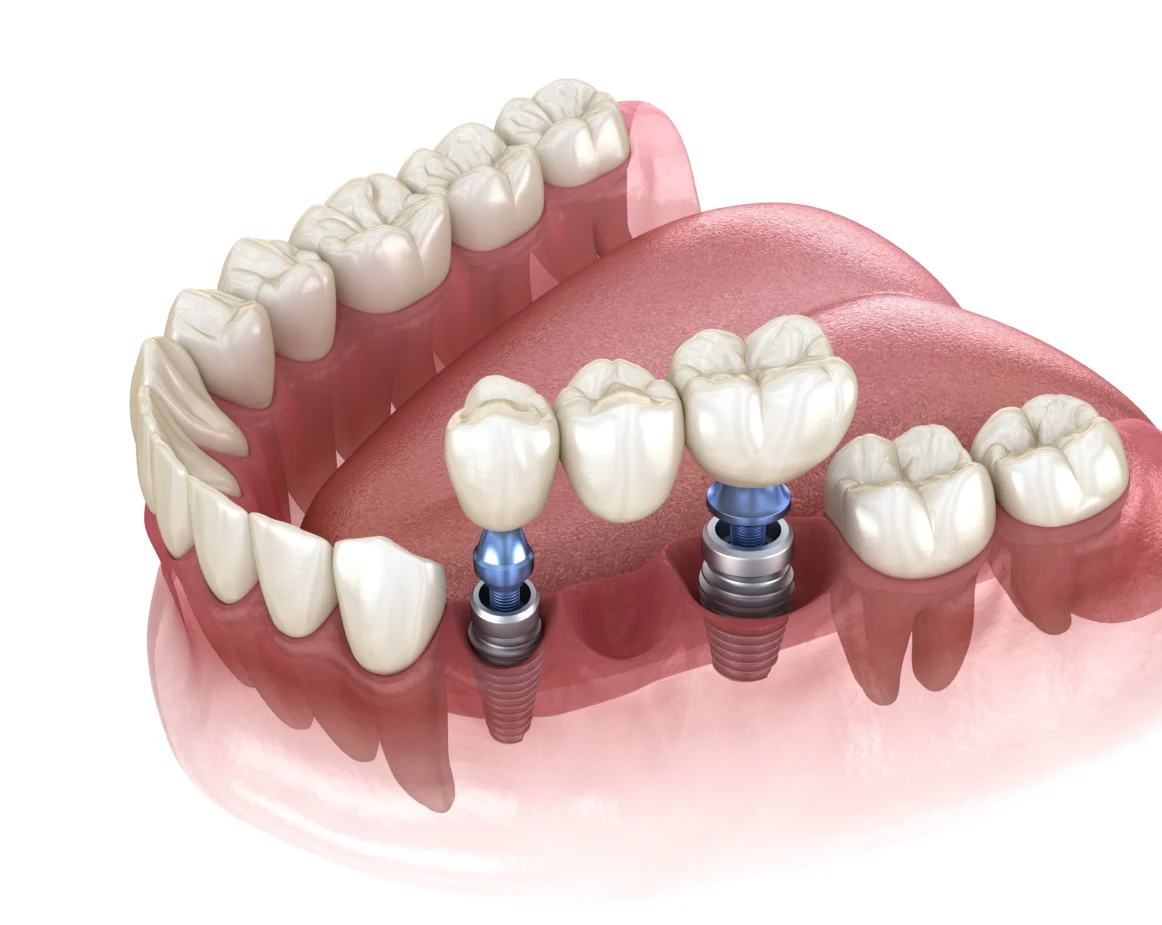 Dental Bridges