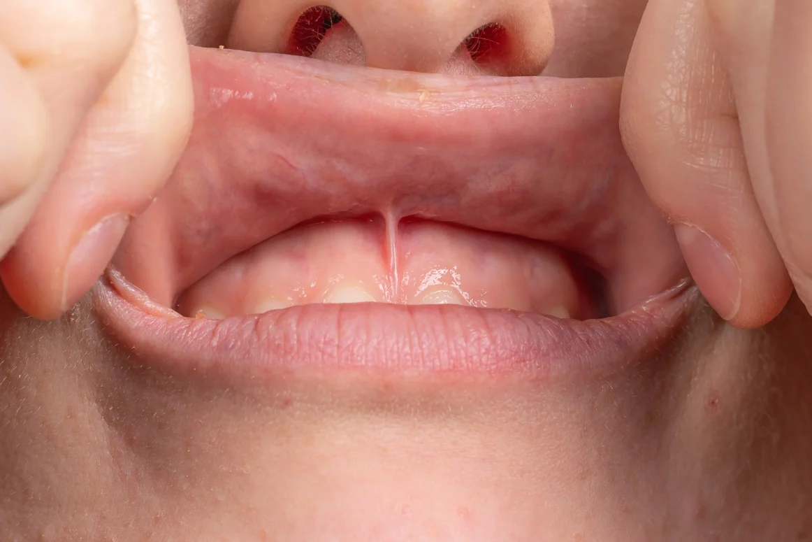 Frenectomy