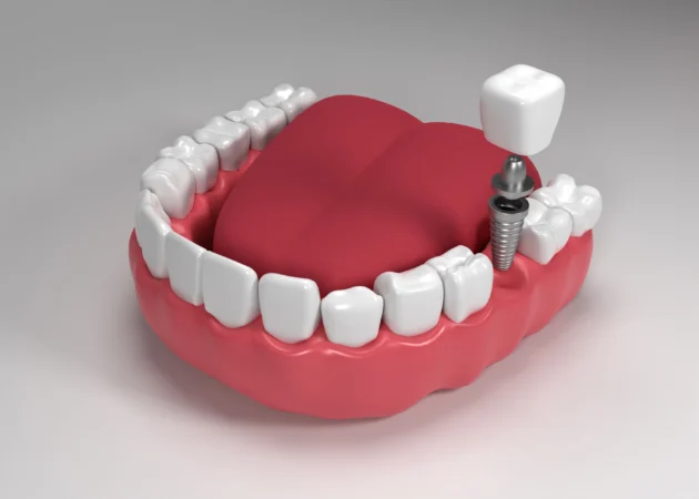 Single Tooth Replacement with Dental Implants