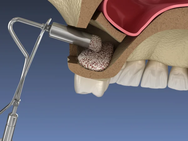 Is a Sinus Lift Required for Dental Implants?