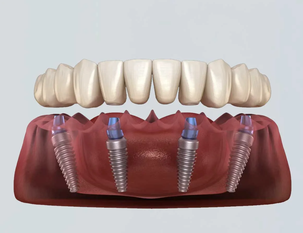 All-on-4 Dental Implants