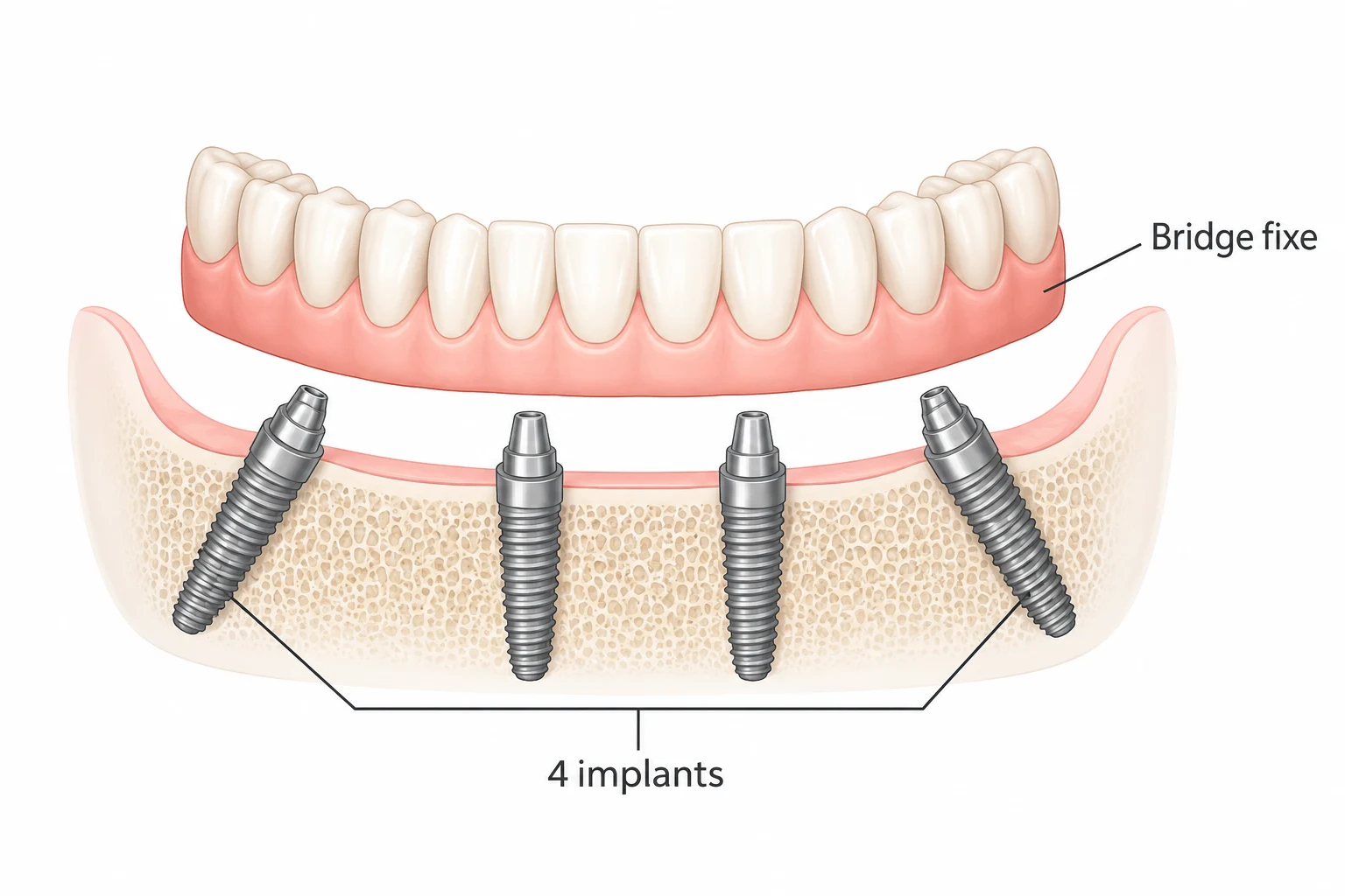 La technique est devenue populaire parce que les implants postérieurs angulés réduisent souvent la nécessité de greffes osseuses importantes à l’arrière de la mâchoire. Mais « souvent » ne signifie pas « toujours » — et cette distinction compte, car des procédures supplémentaires peuvent modifier le coût, le calendrier et l’endroit où il est le plus sûr de placer les implants.